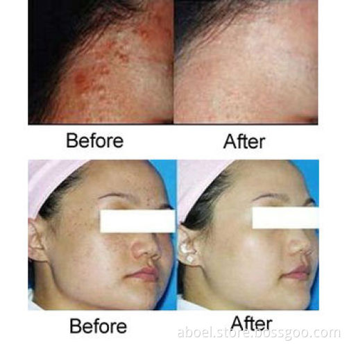 2014 Most Effective CE-/RoHS-approved IPL Beauty Machine for Pimple Removal and Skin Rejuvenation